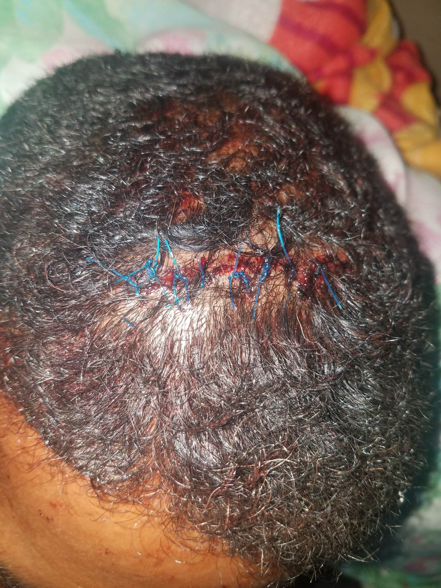 Cubano resulta herido tras caída de un techo en Isla de la Juventud 3