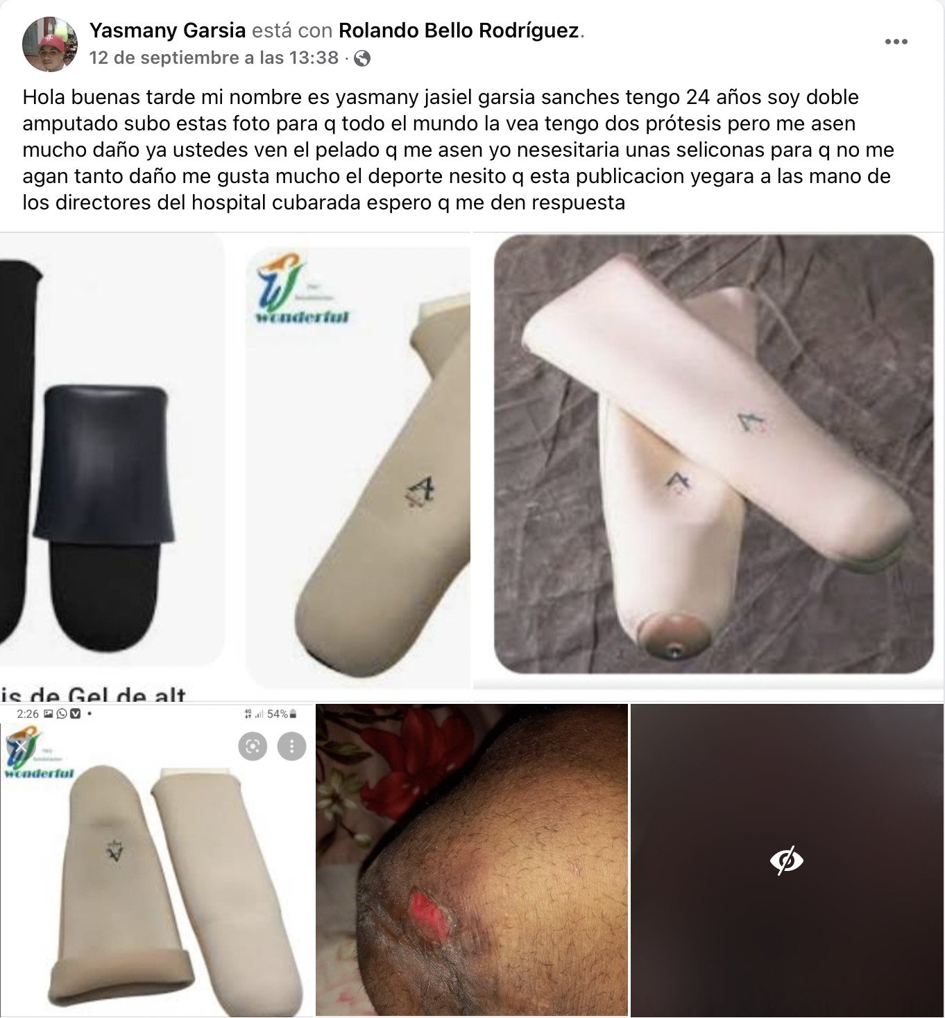 Joven cubano con piernas amputadas pide ayuda para conseguir prótesis 2